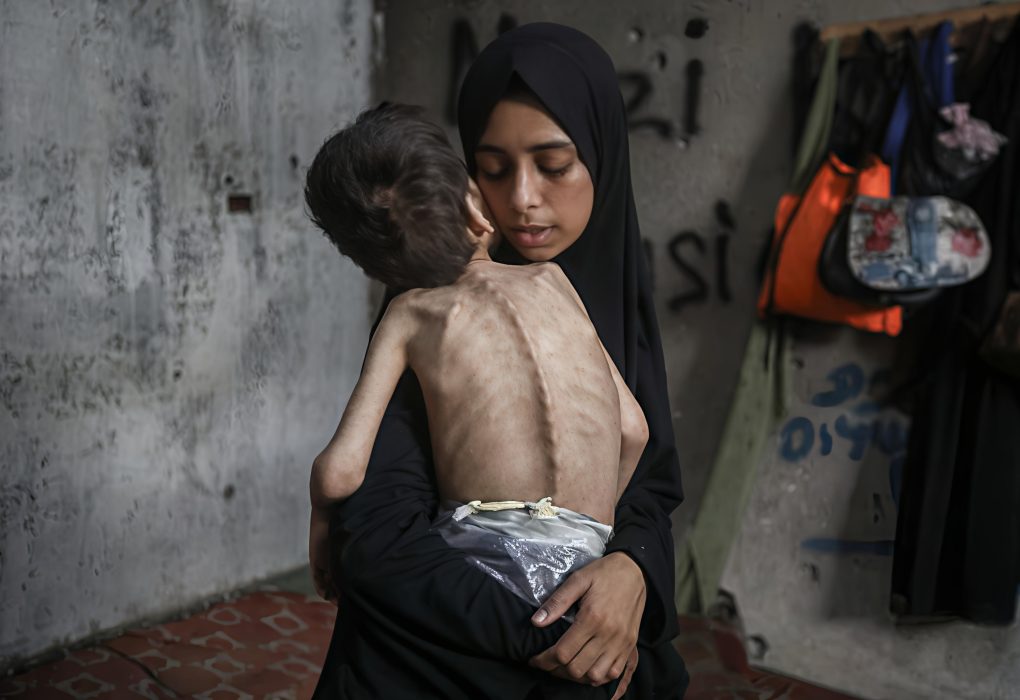 More Deadly Than Bombs: Starvation Claims Children’s Lives in Gaza