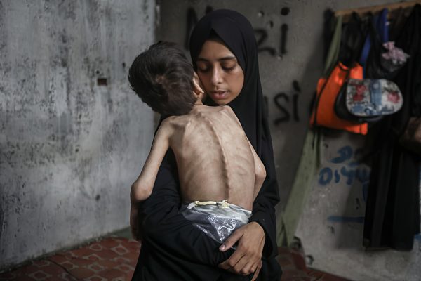 More Deadly Than Bombs: Starvation Claims Children’s Lives in Gaza