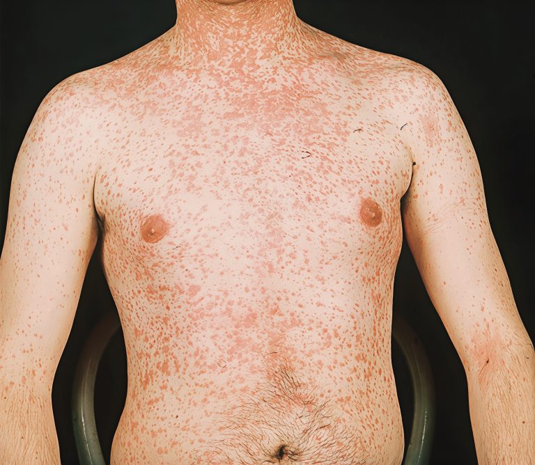 Deadly Measles Threat Resurfaces in Sydney; Public Health Alert Issued